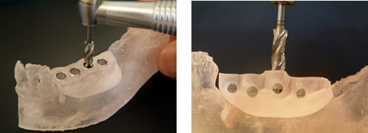 インプラント床の形成(実際に装着するのは患者様の顎の骨になります)