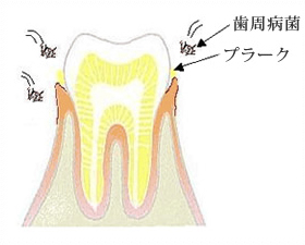 初期の歯周炎（歯肉炎）